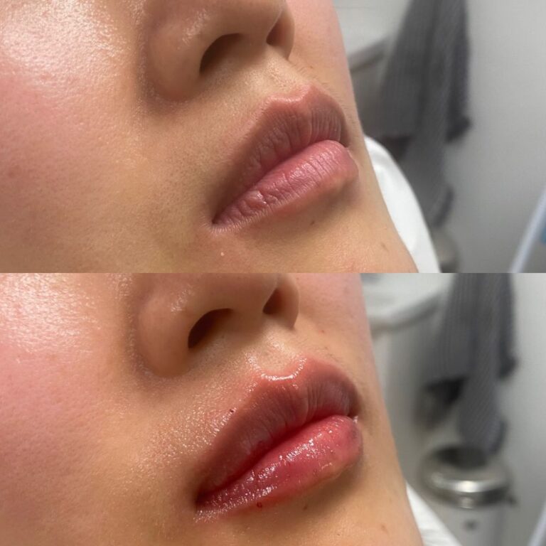 Før og efter lip filler