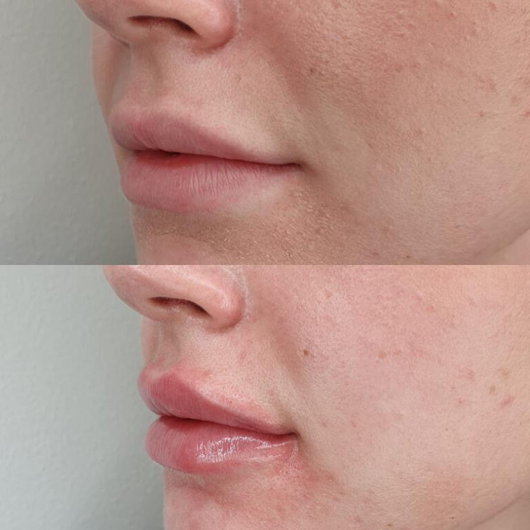 Før og efter lip filler