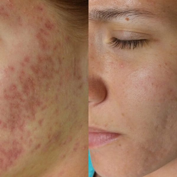 klinik-lindhardt-skinpen-behandling-1