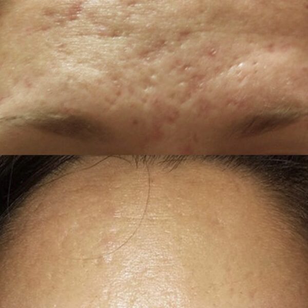 klinik-lindhardt-skinpen-behandling